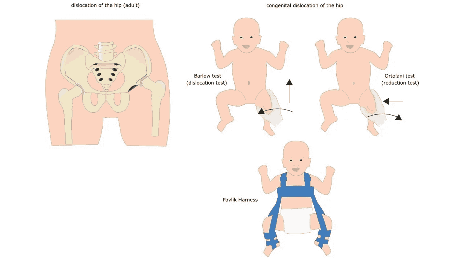 Early Signs of Hip Dysplasia in Babies Parents Should Watch For