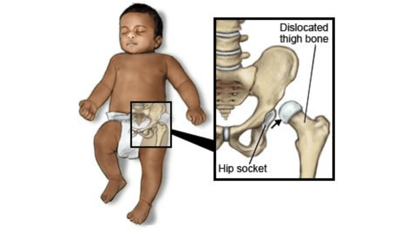 Hip Disorders in Children – Symptoms Parents Should Never Ignore