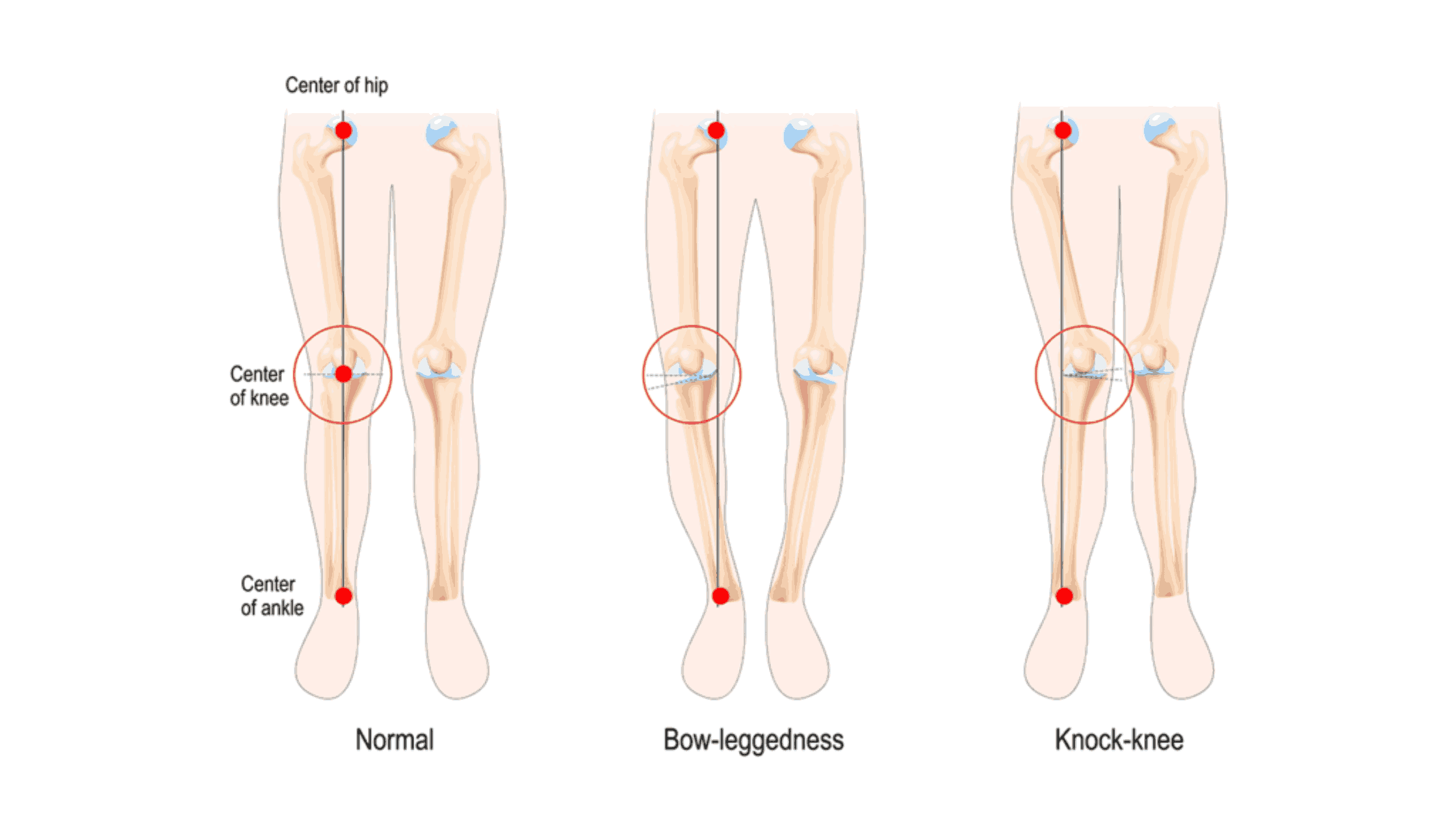 Knock Knees and Bow Legs in Children – When to Worry?