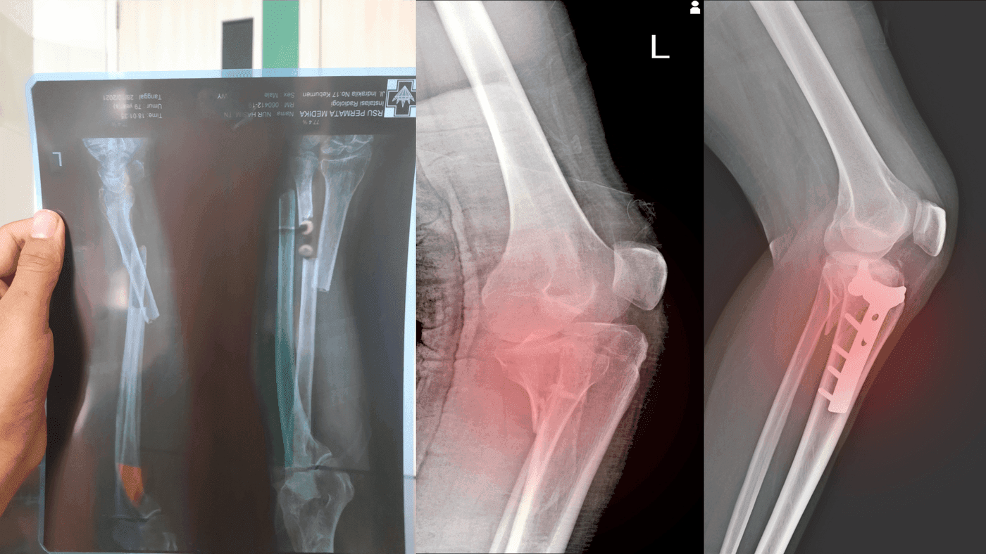 Post-Fracture Care – Helping Your Child Heal and Regain Strength