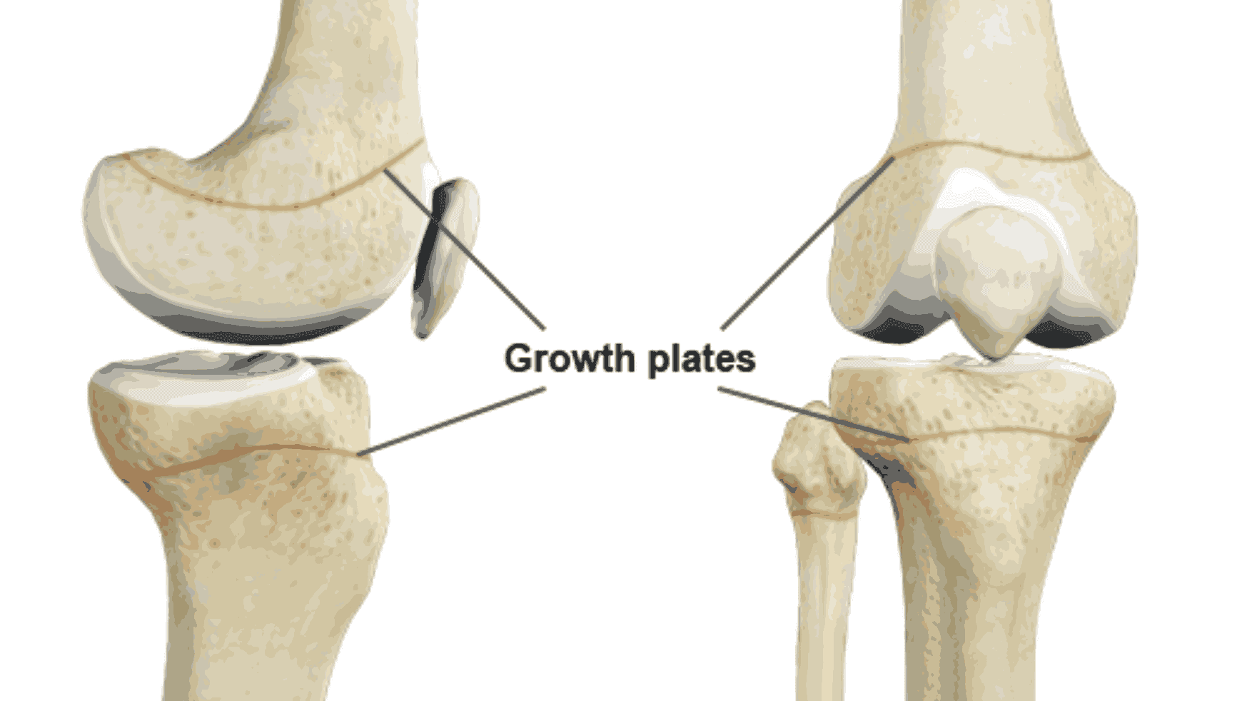 Understanding Growth Plate Injuries – Impact on Future Height