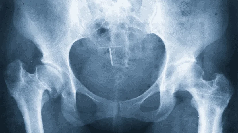 Best Age for Correcting Bone Deformities in Children