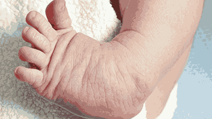 Clubfoot in Newborns: Early Detection and Treatment Options