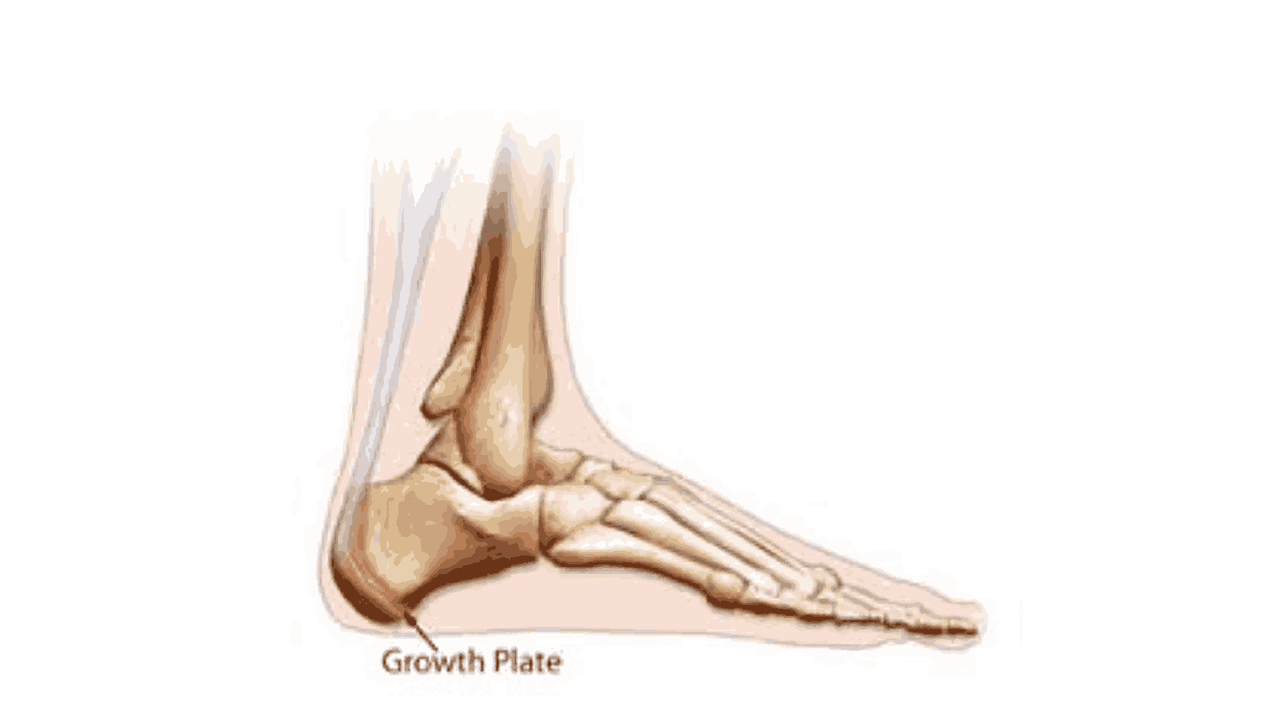 Growth Plate Injuries in Children: Causes, Symptoms, and Treatment