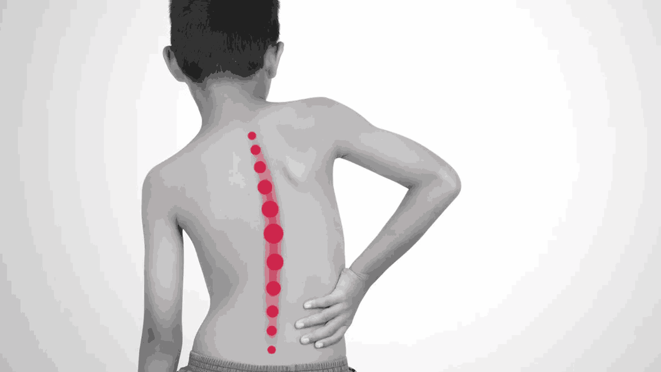 Scoliosis in Kids: Warning Signs Parents Shouldn’t Ignore