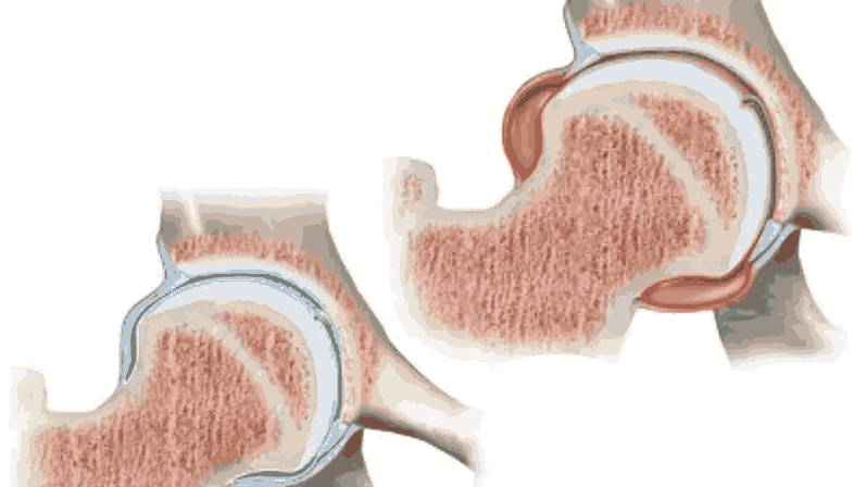 Limping in Children: Common Causes and When to See a Doctor