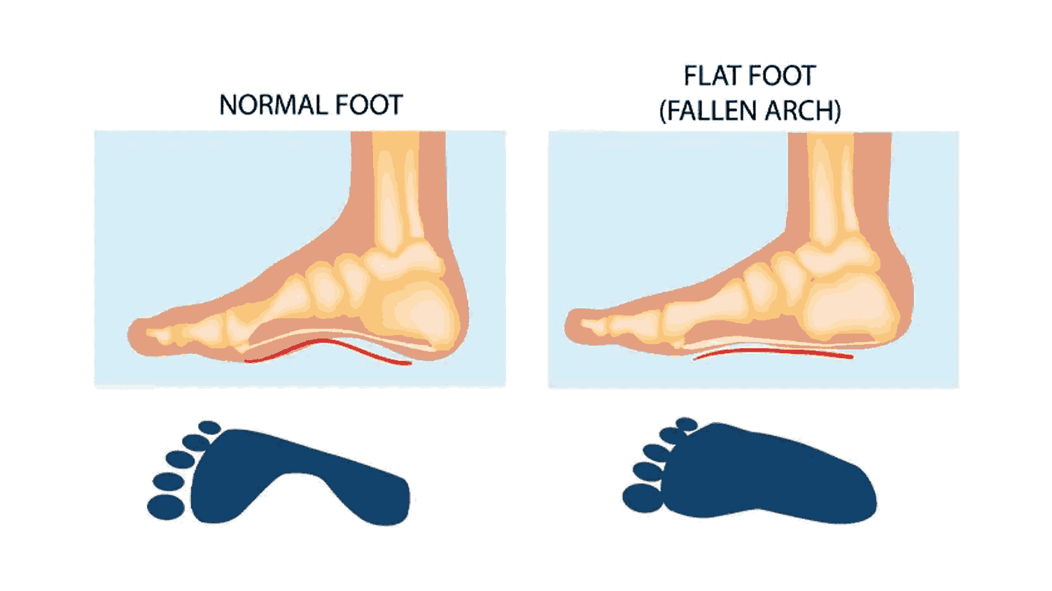 Flat Feet in Children: When to Worry and What to Do