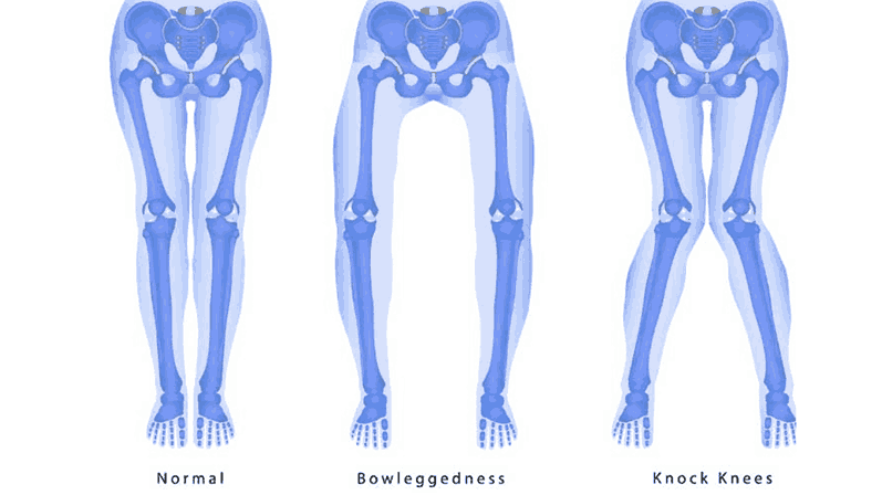 Knock Knees vs. Bow Legs: What’s Normal in Growing Kids?