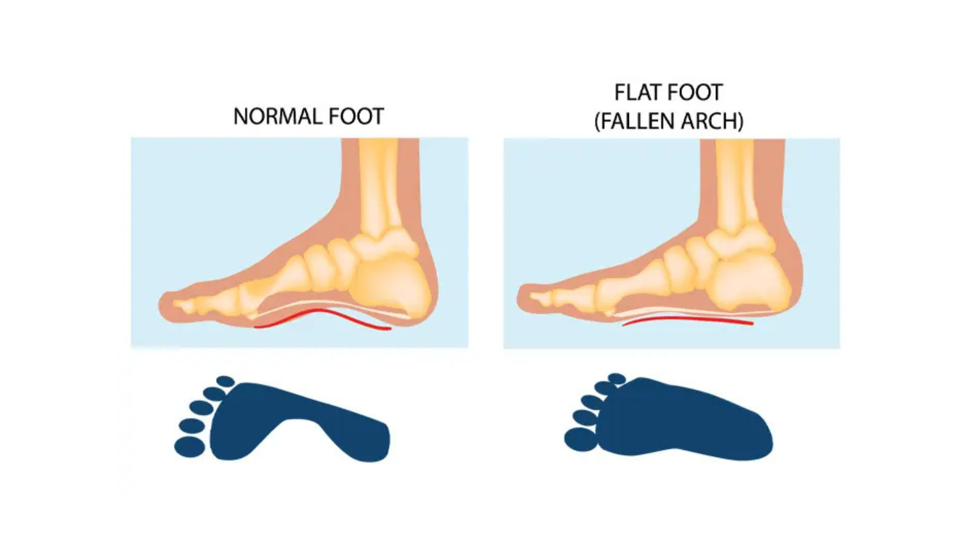Flat Feet in Children: What’s Normal and When to Seek Help?