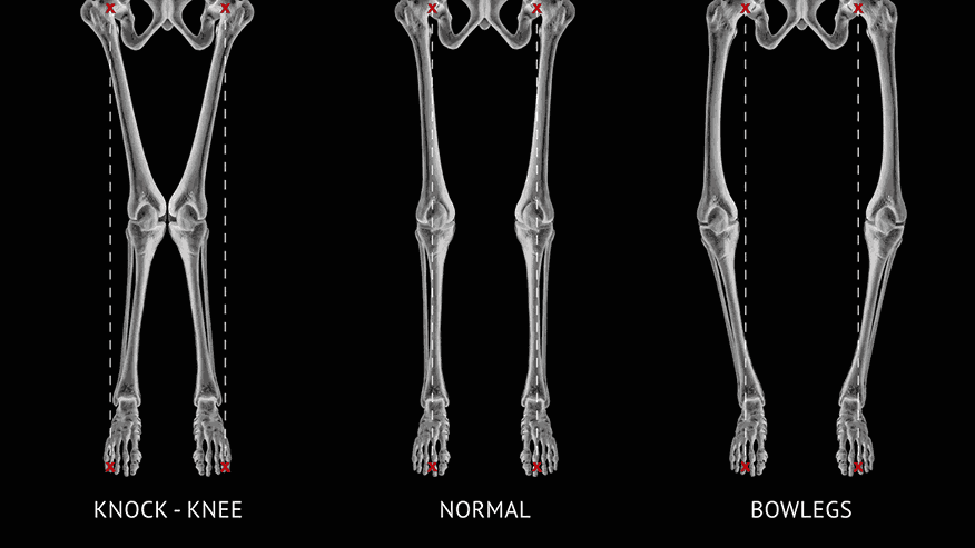 Knock Knees and Bow Legs: What’s Normal and What’s Not?