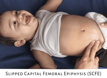 Early Treatment for Clubfoot: Why It Matters