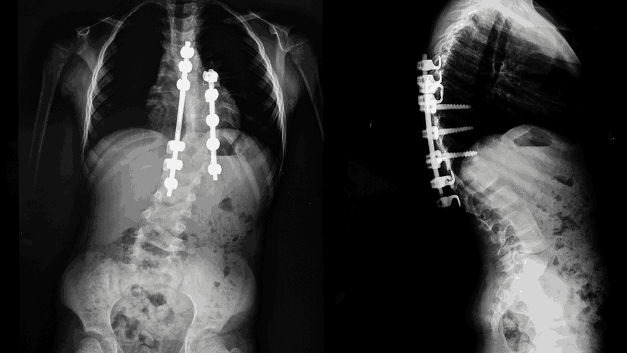 Early Signs and Care for Pediatric Scoliosis
