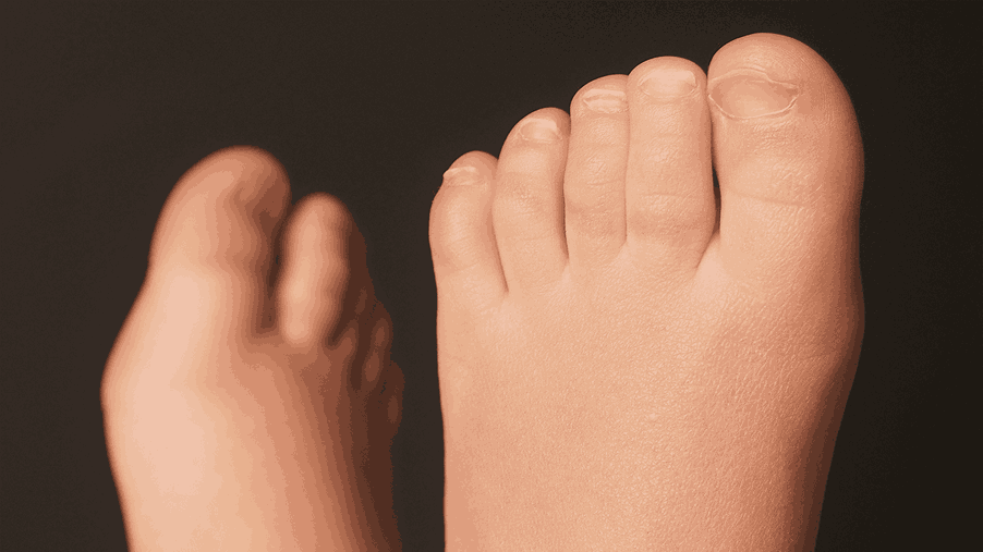 Is Your Child’s Clubfoot Coming Back?