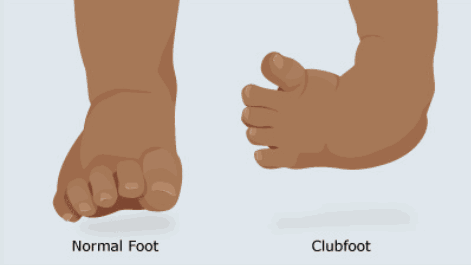 Understanding Clubfoot in Newborns: Why Early Treatment Matters Most