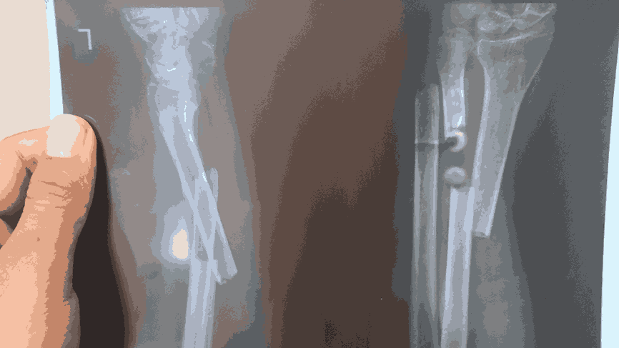Fractures in Children – Why They Heal Faster but Need Care