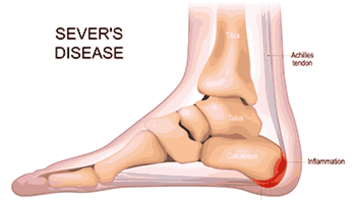 Growth Plate Injuries – Causes, Symptoms, and Recovery