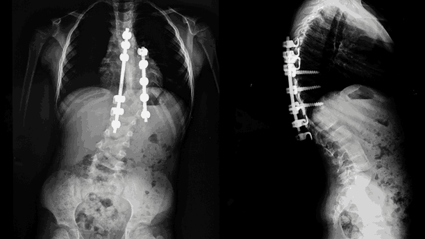How to Recognize and Manage Scoliosis in Children