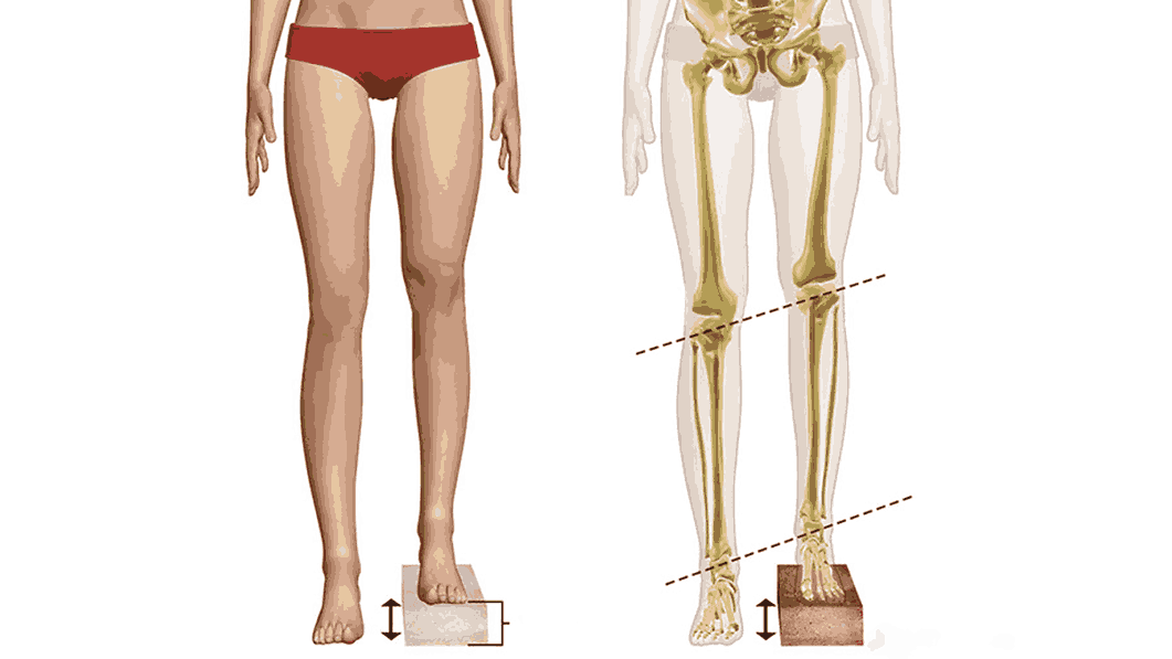 Limb Length Discrepancy – Causes, Detection, and Treatment