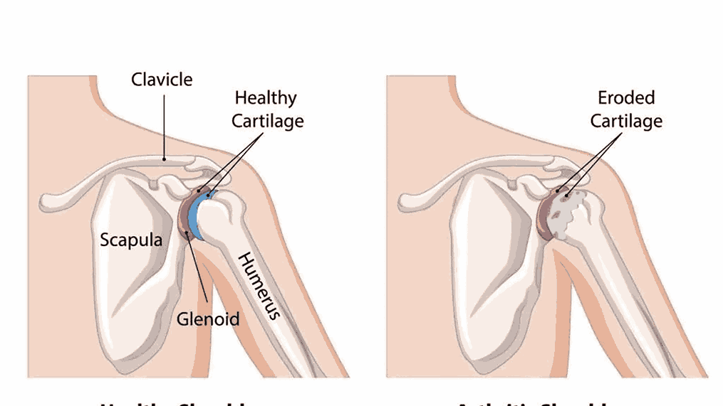 Role of Early Intervention in Preventing Long-Term Bone Issues