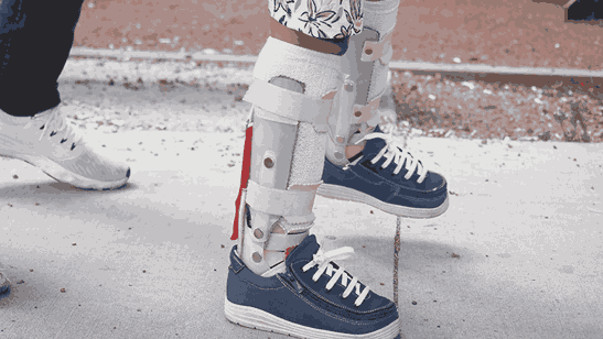 Understanding and Managing Cerebral Palsy-Related Orthopedic Issues