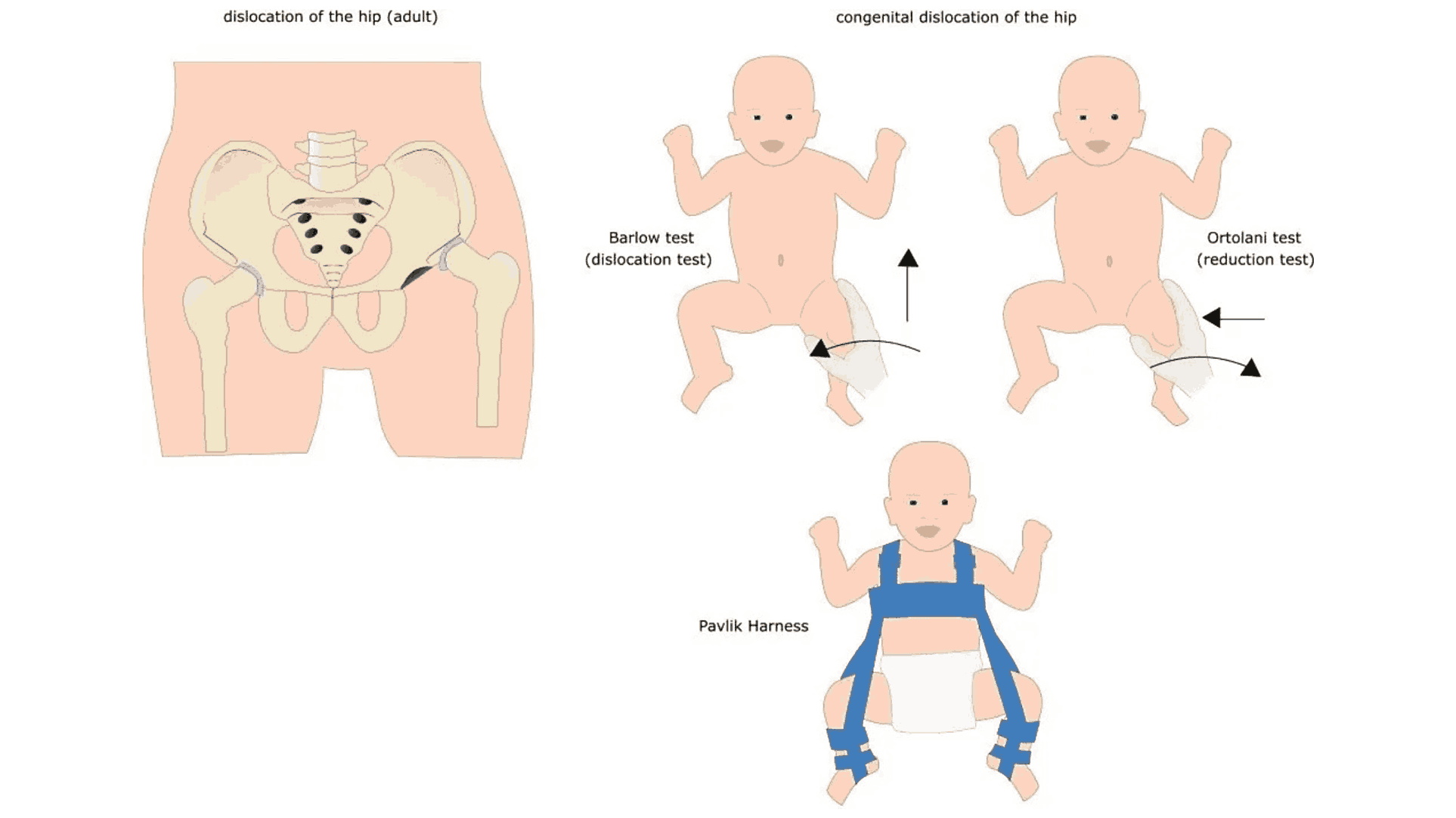 Early Signs of Hip Dysplasia in Babies Parents Should Watch For