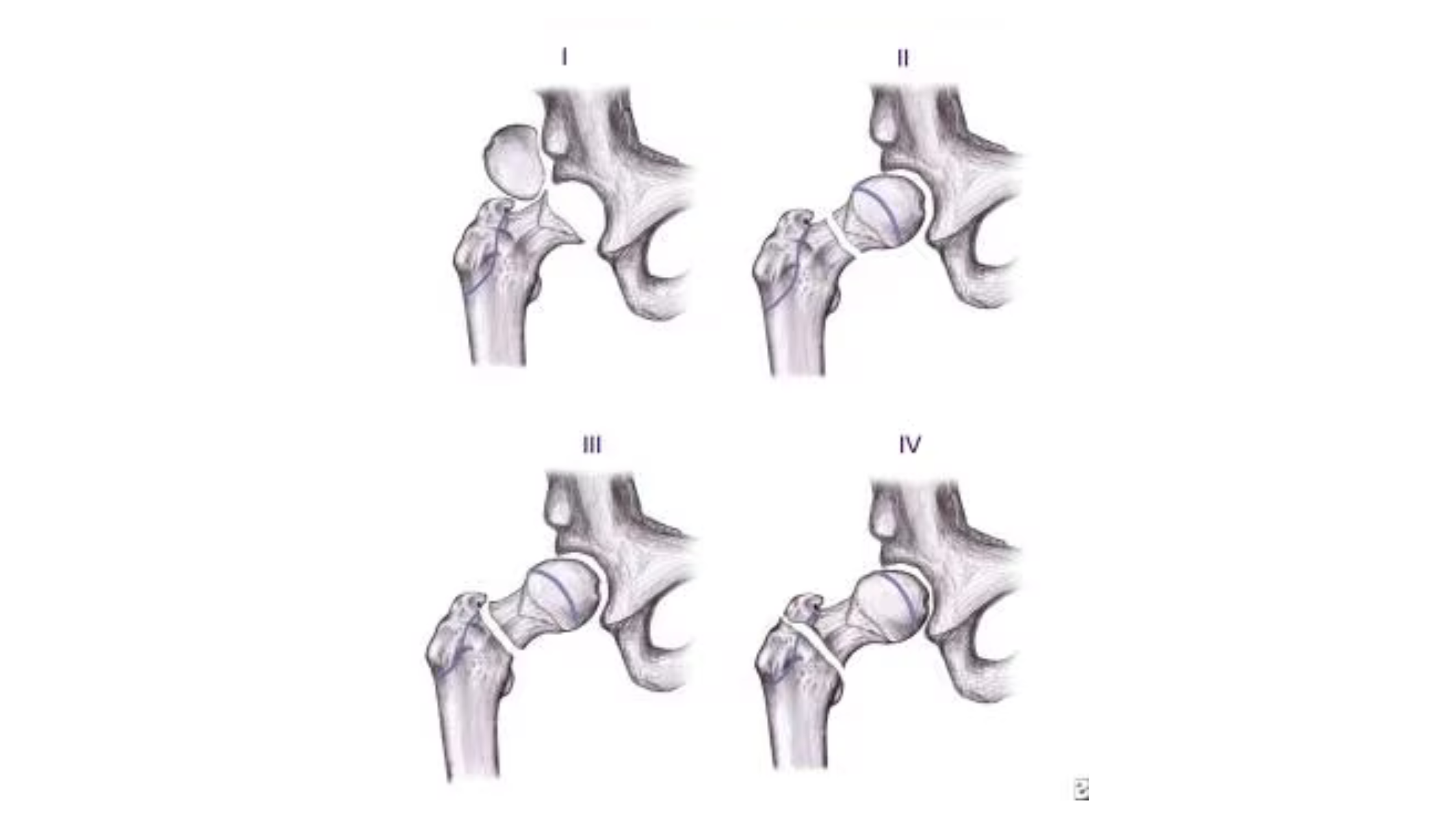 Fractures in Children – Can They Affect Future Growth?